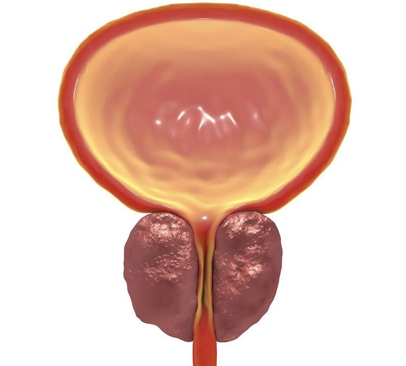 prostatitis kronikoaren hantura