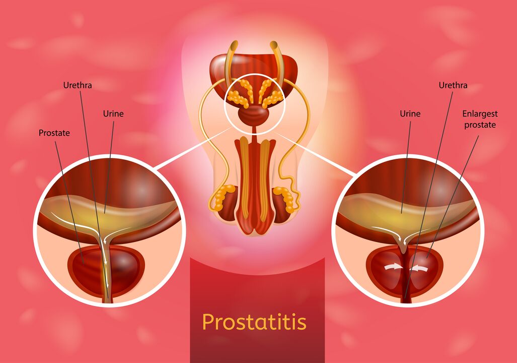 Prostatitxi