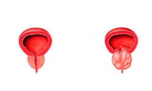 osasuntsu eta hanturatutako prostata prostatitisarekin